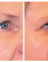 Инъекции Ботокс вокруг глаз: фото до и после